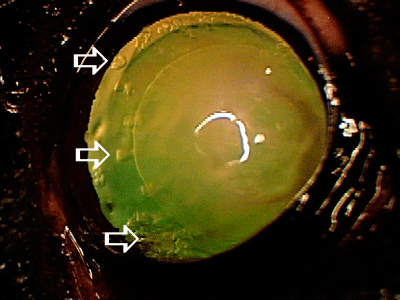 early cataract